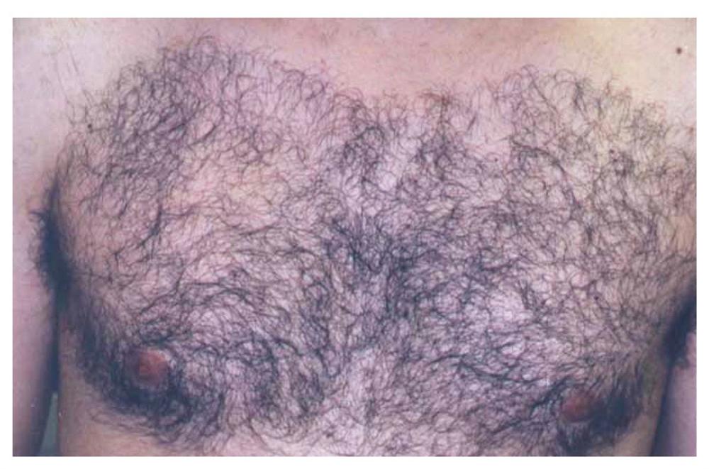 Hair Removal Pre Treatment